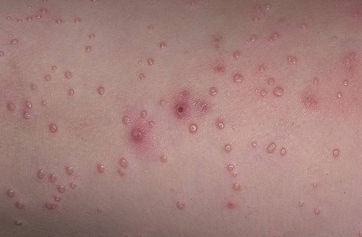 Контагиозный моллюск – кожное вирусное заболевание у детей