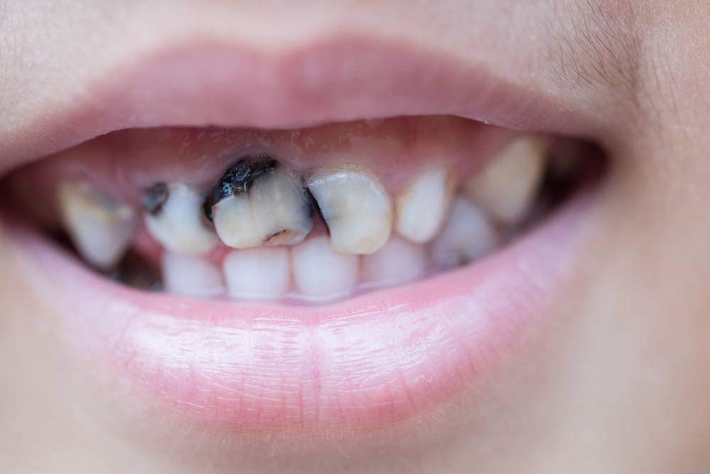 У ребенка болит зуб: причины, лечение и как помочь при сильной зубной боли