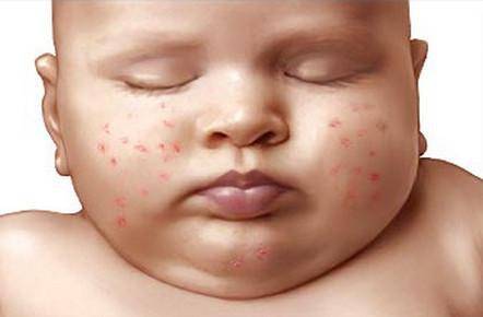 Желтые прыщи у новорожденных. маленькие красные и белые прыщики у новорожденного на лице и голове: нужно ли их обрабатывать и чем-то мазать? аллергия – как выглядит, что это, причины появления