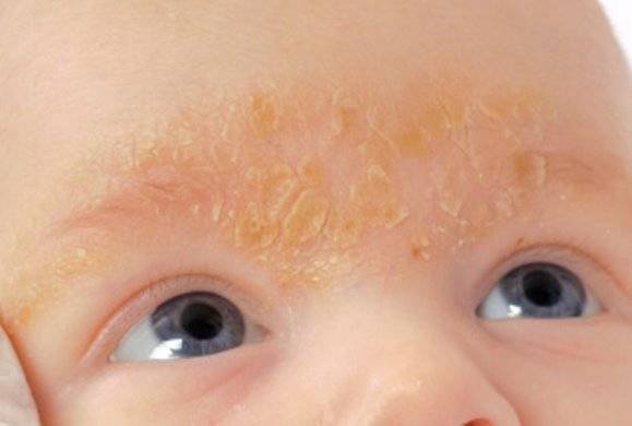 Шелушится кожа у новорожденного — причины, лечение