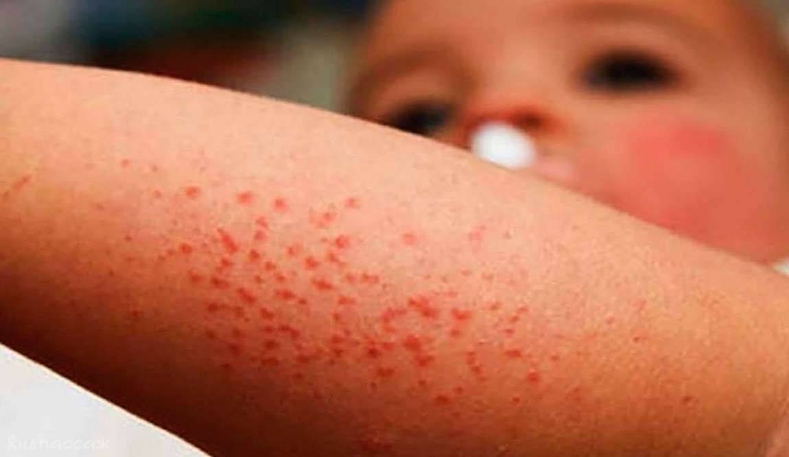 Сыпь на теле у ребенка после высокой температуры: возможные причины