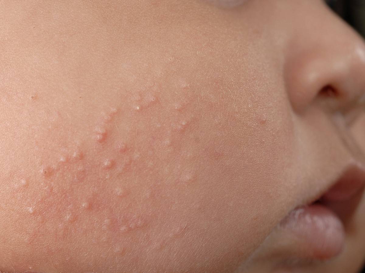 Виды аллергии на коже, какие бывают высыпания на фото