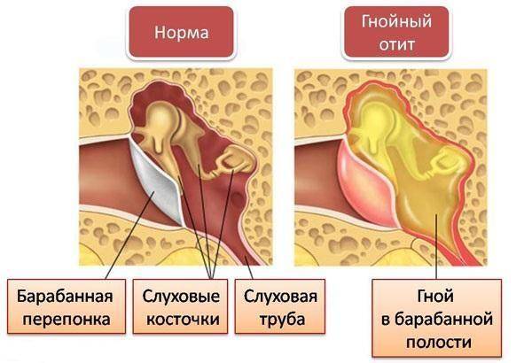 Кровь из уха у ребенка — опасный симптом, который может быть вызван как травмой, так и онкологией