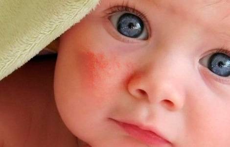 Аллергия на сладкое у детей: как выглядит, симптомы, лечение, диета