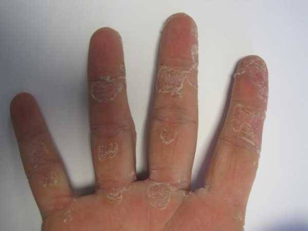 Почему облазит кожа на пальцах рук и ног у ребенка — возможные причины и лечение