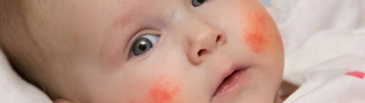 Аллергия на гречку - запись пользователя янина (yanochka-t) в сообществе питание новорожденного в категории пищевая аллергия - babyblog.ru