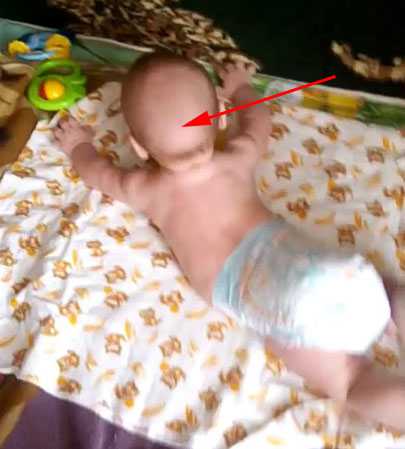 Лысина на затылке признак рахита? - запись пользователя nadezhda (id1334131) в сообществе здоровье новорожденных в категории рахит и его профилактика - babyblog.ru