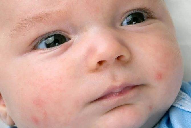 Водянистые пузырьки на коже ребенка. Причины, лечение, профилактика