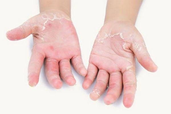Почему между пальцами ног и рук у ребенка облазит кожа? причины и пути борьбы с заболеванием