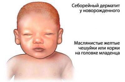 Шелушение кожи у новорожденного на теле, лице, голове. фото, что делать, лечение