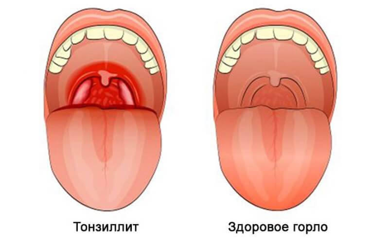 Лечение и профилактика красного горла у ребенка