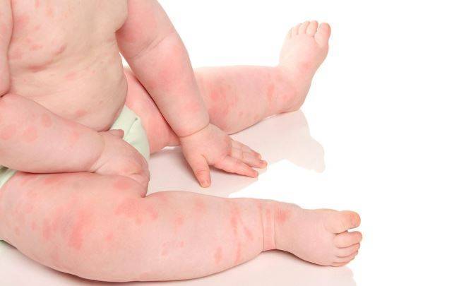 Аллергия на антибиотики – какие препараты считаются самыми опасными?