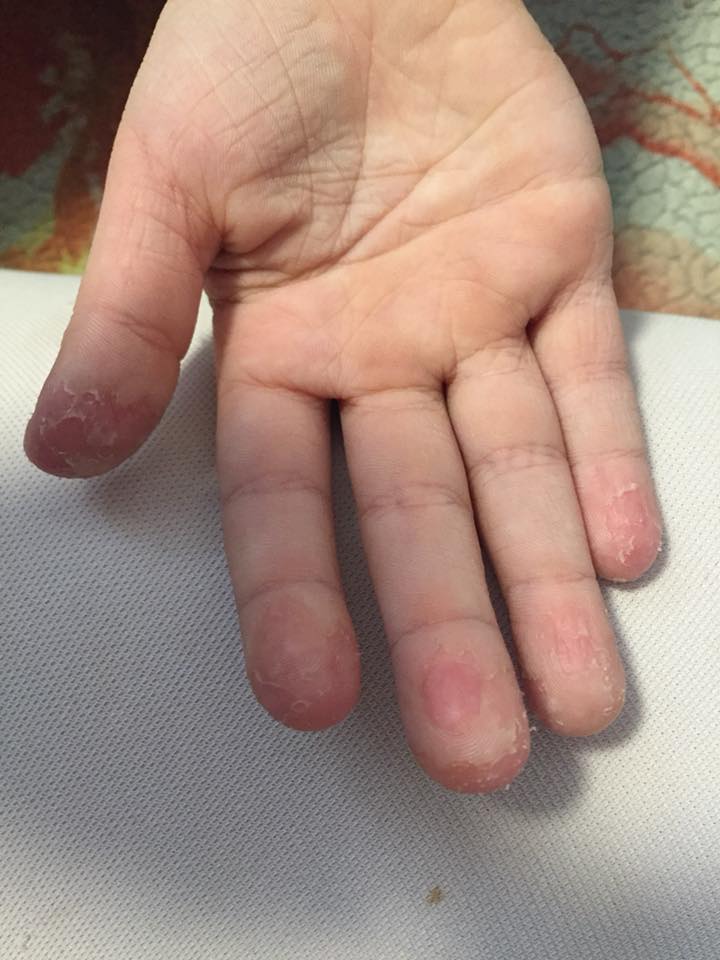 Облазит кожа на пальцах рук у ребенка: на подушечках, между пальцами