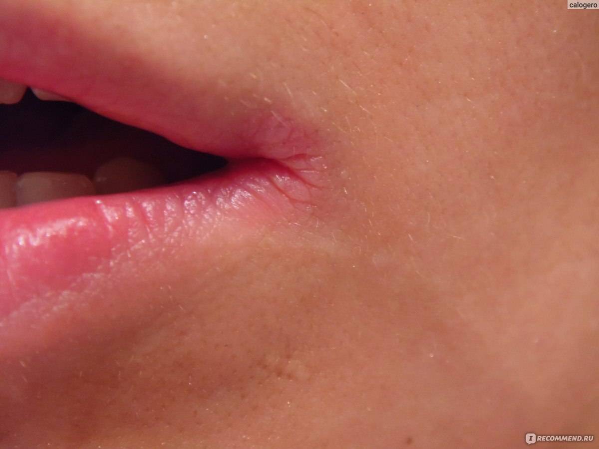 Почему возникают заеды в уголках рта у детей и как от них избавиться