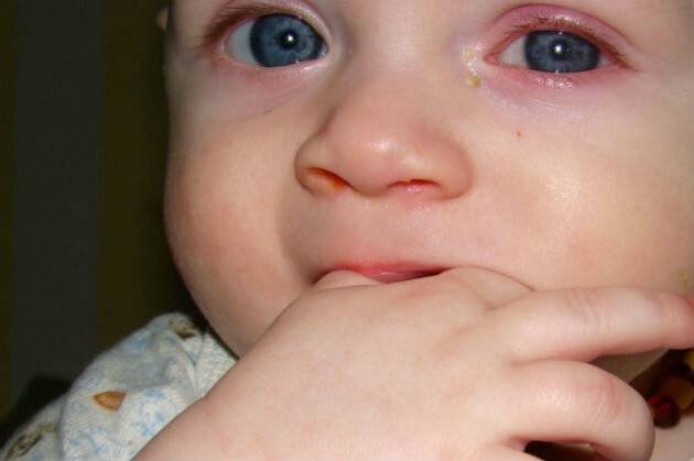 Не могу закапать капли в глаза - запись пользователя анастасия (nastya2013) в сообществе детские болезни от года до трех в категории консультация детского офтальмолога! - babyblog.ru