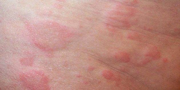 Аллергия у ребенка. причины, симптомы, лечение и профилактика аллергии