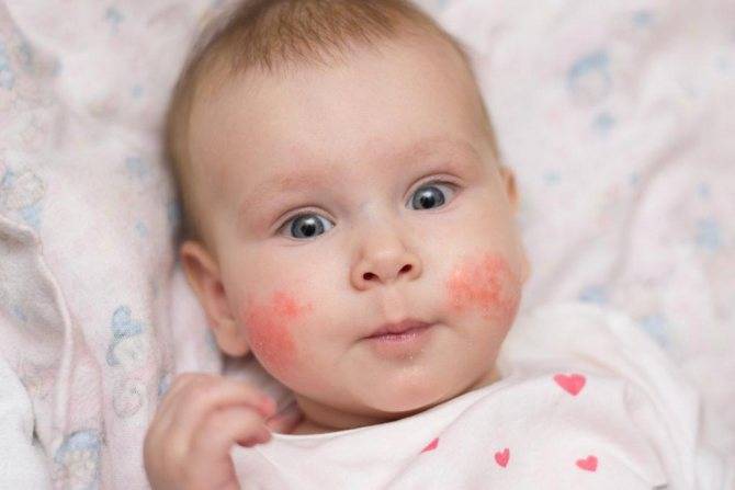 Аллергия у новорожденного пищевая при грудном вскармливании. как выглядит на лице, ушах, теле. лечение: капли, крема, мази