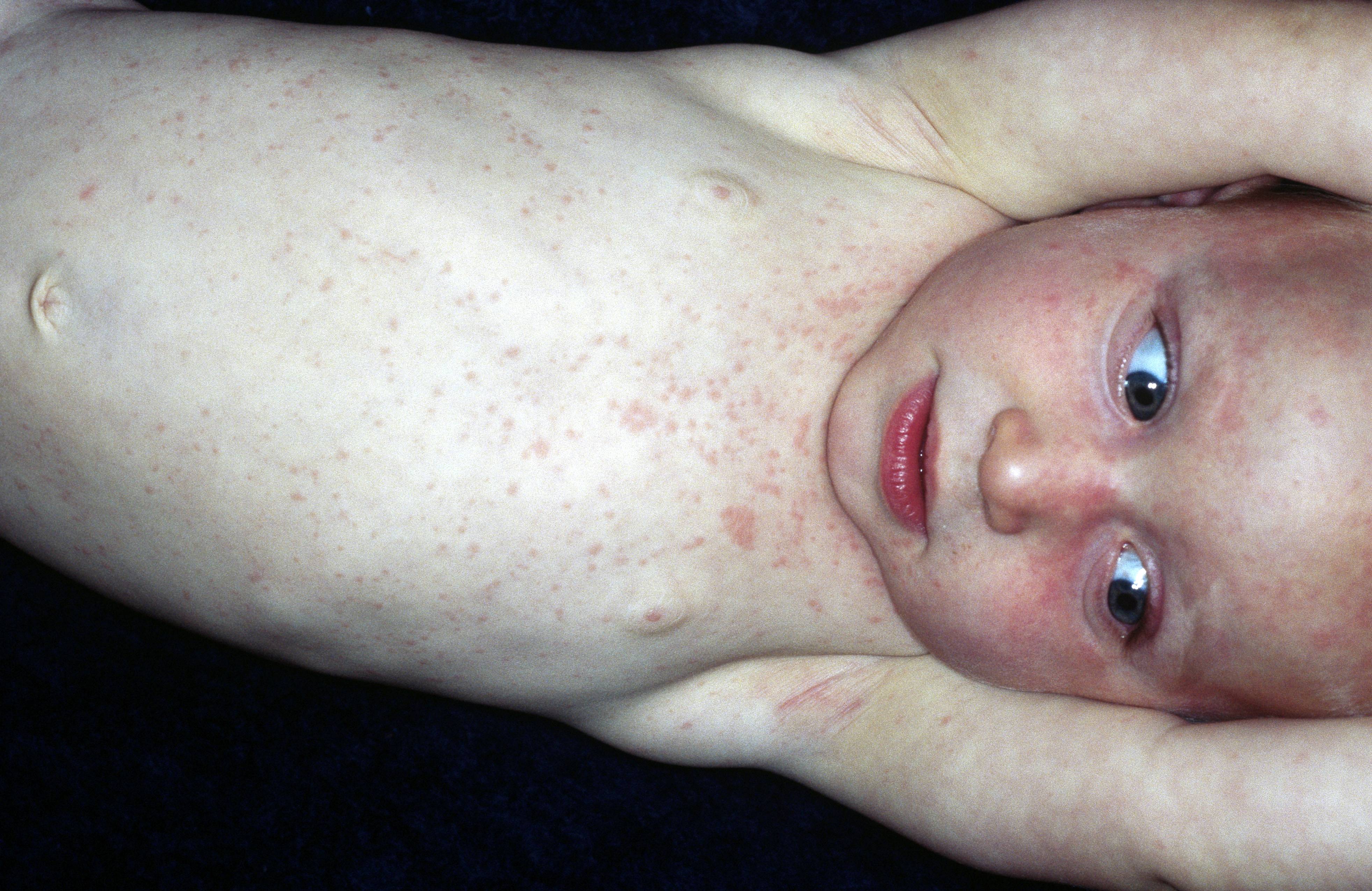 Е. комаровский: розеола (11 фото): симптомы и лечение детской болезни