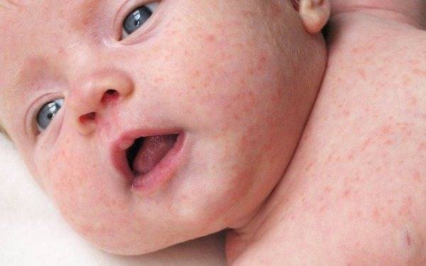 Крапивница у грудничка и новорожденного (12 фото): симптомы и лечение. как выглядит на лице у грудного ребенка? чем лечить и что делать?