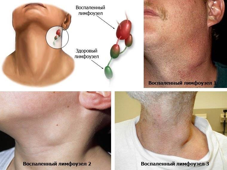 Шейный лимфаденит у детей: лечение и причины воспаления лимфоузлов на шее