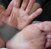 У ребенка сыпь на руках — что это такое, причины высыпаний
