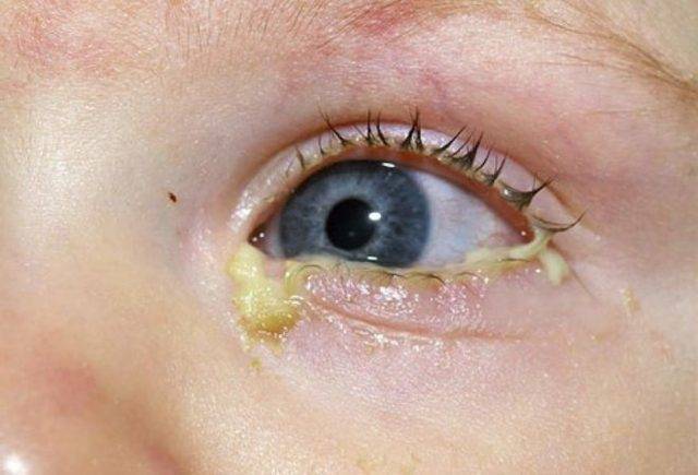 У ребенка насморк и гноятся глаза: причины и лечение