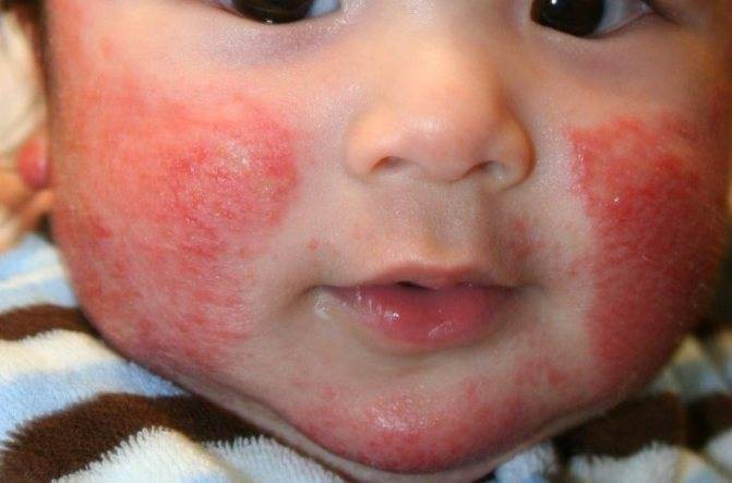 Аллергия на лице, животе и теле у грудничка: лечение. симптомы у грудничка на аллергию пищевую, на пыльцу, стиральный порошок, холод, солнце, контактную