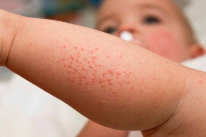 Аллергия в виде гусиной кожи и причины: на руках, ногах у взрослого и ребёнка