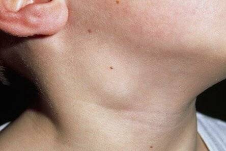 Лимфоузлы на шее у ребенка: причины увеличения и воспаления, лечение
