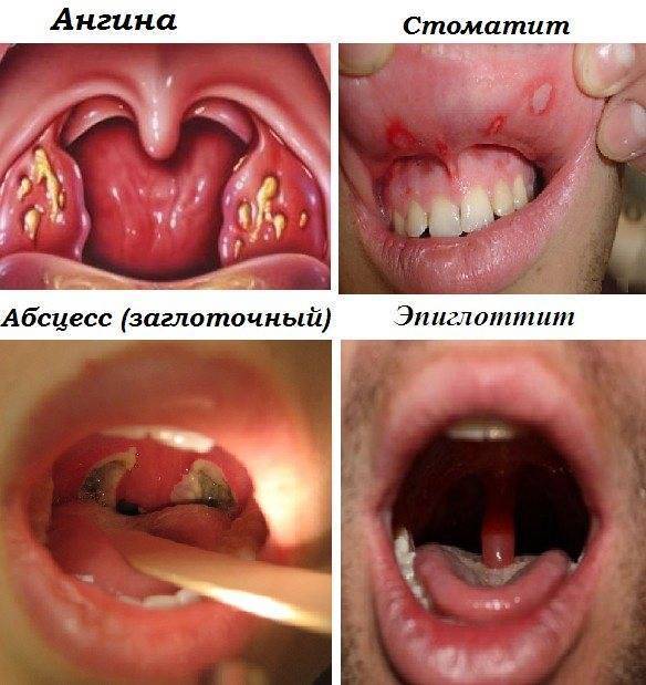Сыпь в горле: причины и лечение