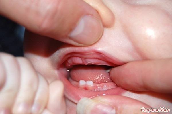Сколько дней держится температура у детей при прорезывании молочных зубов