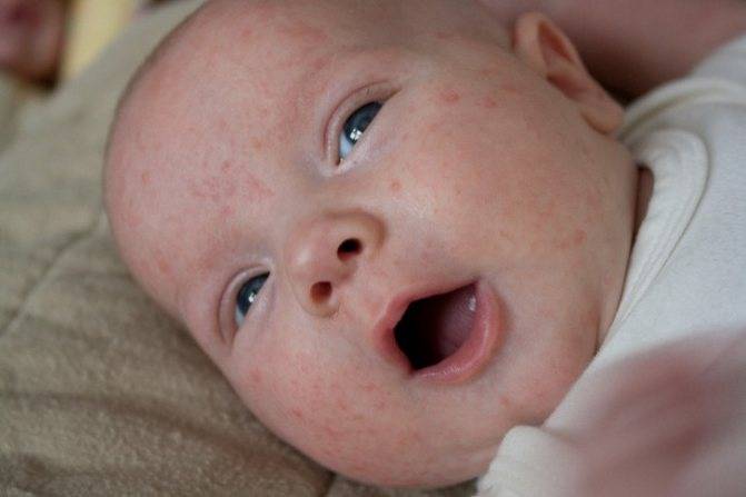 Температура и сыпь у ребенка: что означает данная симптоматика у детей
