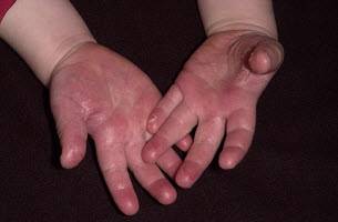 Почему облазит кожа у ребенка? облазит кожа на пальцах: что делать?
