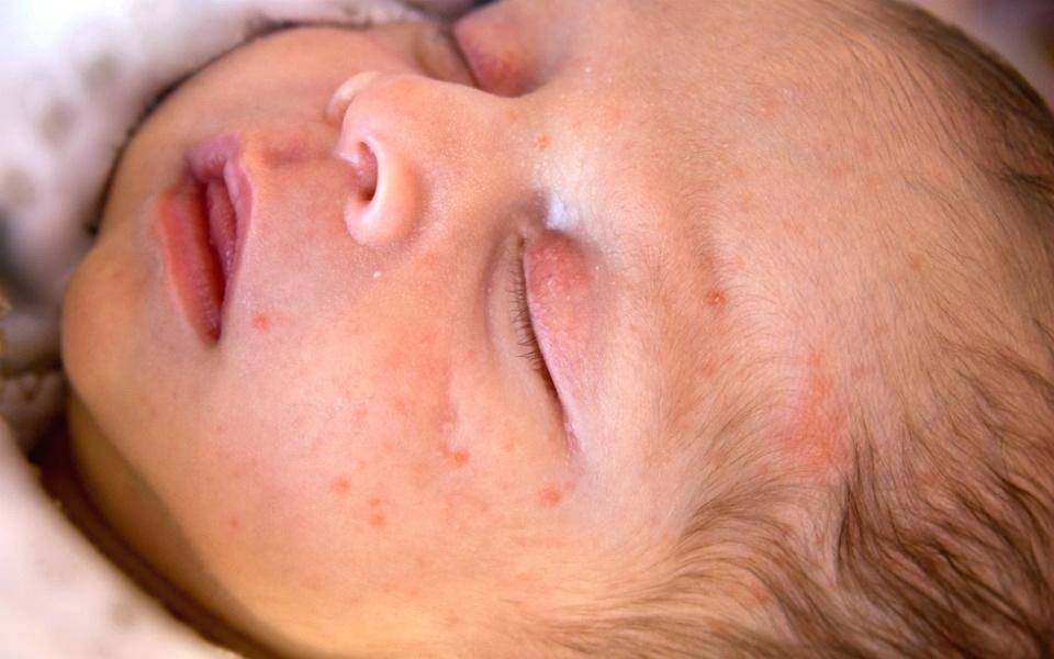 Гормональная сыпь у новорожденных (22 фото): как выглядят высыпания у грудничка на лице