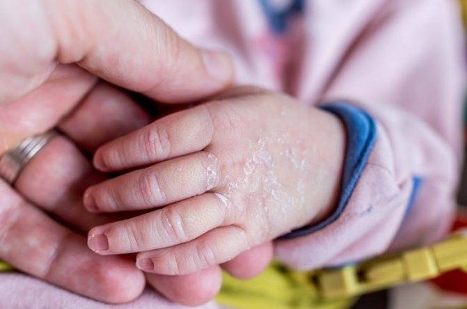 У ребенка облазит кожа на руках причины и лечение