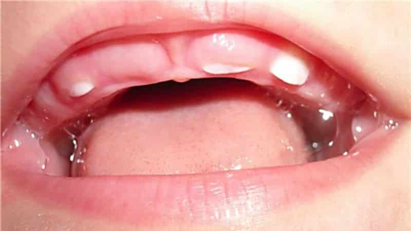 Какие зубы прорезаются у детей до года - много зубов