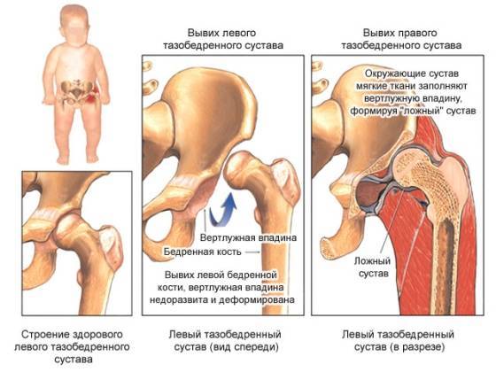 Дисплазия тазобедренного сустава у грудничка (новорожденного)