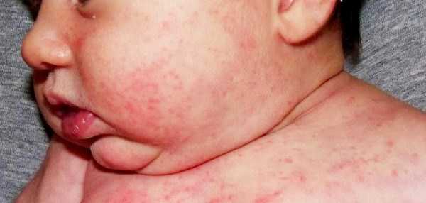 Аллергия на лице у грудничка: как выглядит, чем мазать, сколько проходит