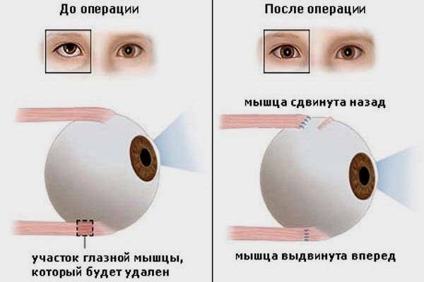 Косоглазие - косоглазие у новорожденных - запись пользователя mam зелька (mam3elka) в сообществе здоровье новорожденных в категории болезни глаз - babyblog.ru