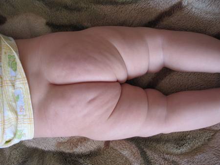 Несимметричные складочки - запись пользователя мама двух принцесс (lena_13) в сообществе здоровье новорожденных в категории ортопедия - babyblog.ru