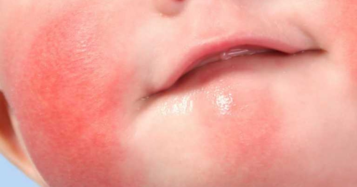 Гормональная сыпь у новорожденных (22 фото): как выглядят высыпания у грудничка на лице