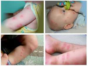 Высыпания на теле у ребенка и зуд: что делать, если кожа с сыпью чешется на спине, шее и стопах