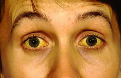 Почему у новорожденных могут быть желтые белки глаз