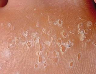 Шелушится кожа на ногах у ребенка, новорожденного. причины и лечение