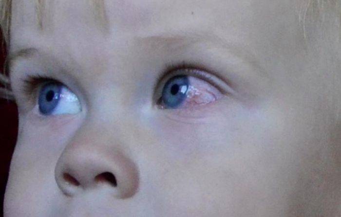 Что делать, если глаза у ребенка красные и опасно ли это?