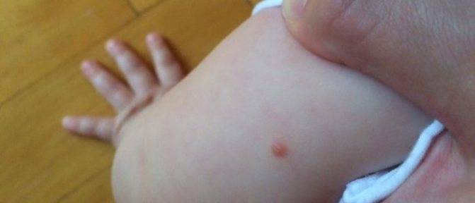 Allergiya-v-vide-krasnyh-pyaten-na-tele - запись пользователя катюша (katerin_ka_) в сообществе здоровье новорожденных в категории кожные заболевания - babyblog.ru