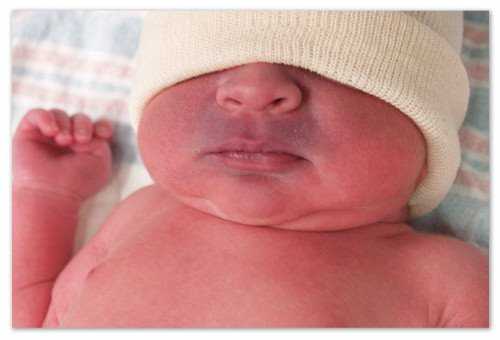 Венка на переносице((( - стр. 1 - запись пользователя лиза (liko18) в сообществе здоровье новорожденных в категории неврология - babyblog.ru