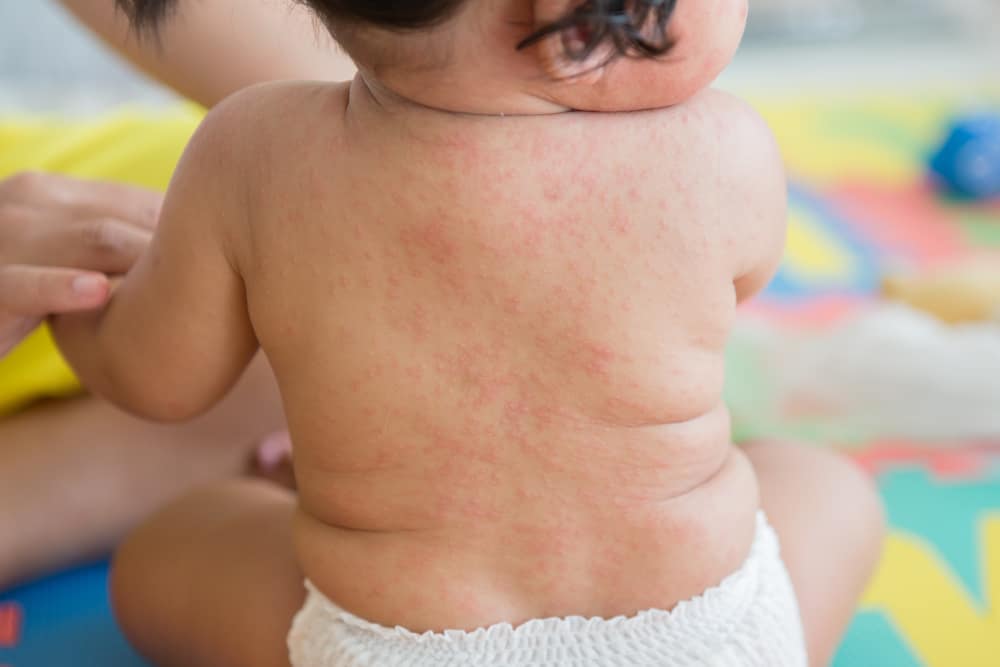 Аллергия у новорожденных на лице