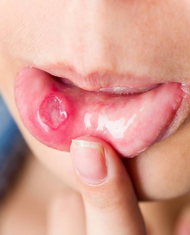 Что это и как лечить белые язвочки во рту у  ребенка