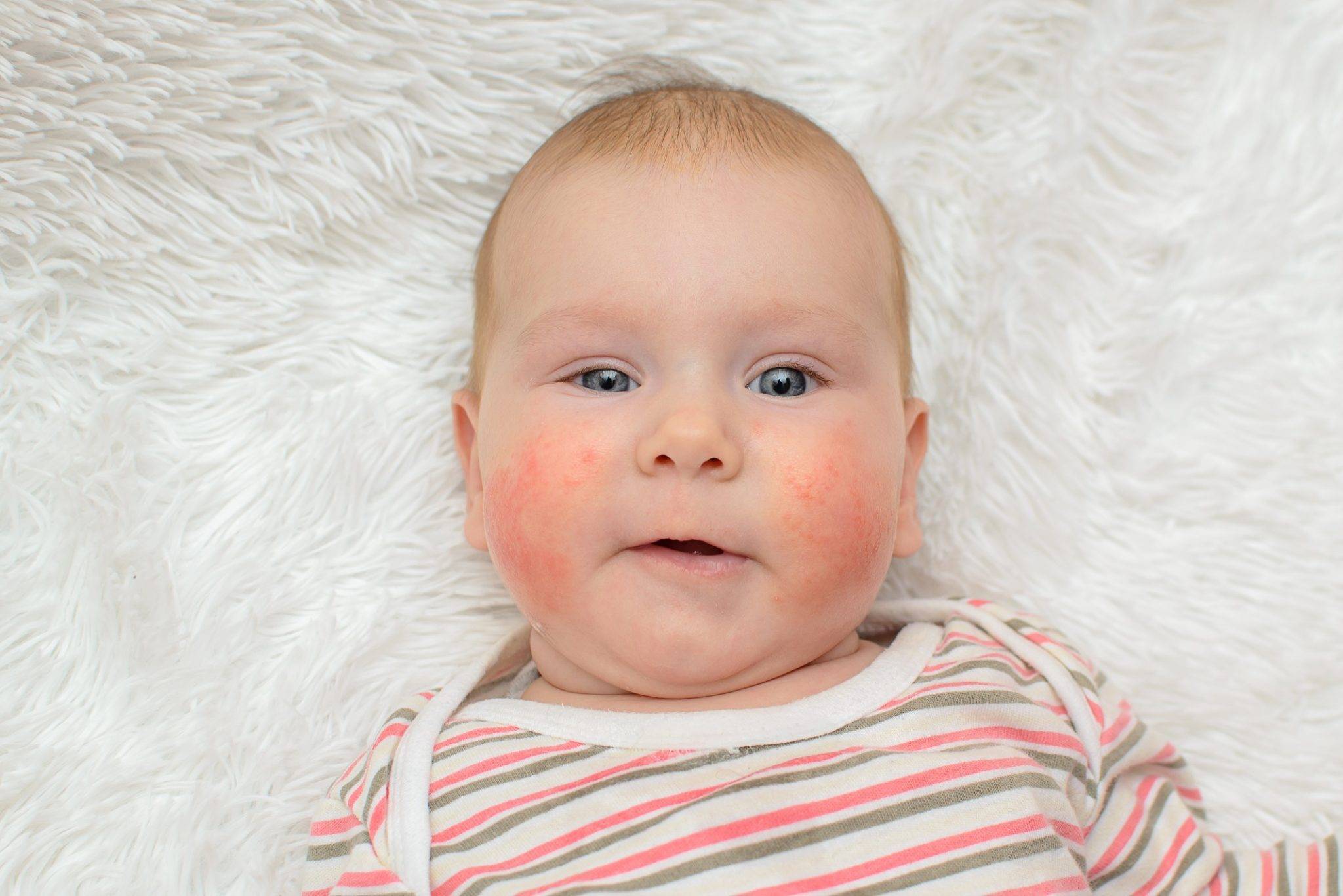 Аллергия у грудничка на лице: особенности проявления